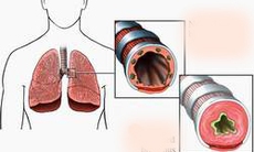Chọn và dùng salbutamol thế nào cho hiệu quả?